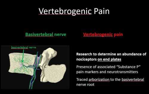 Intracept Procedure Anesthesia