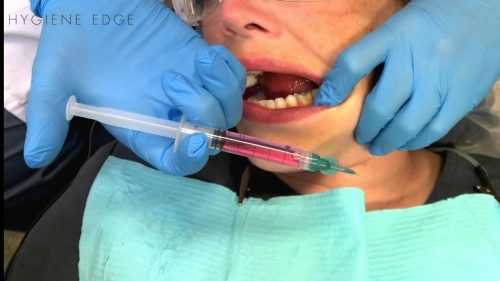 Irrigation Dental Procedure