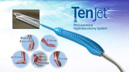 Tenjet Procedure Near Me