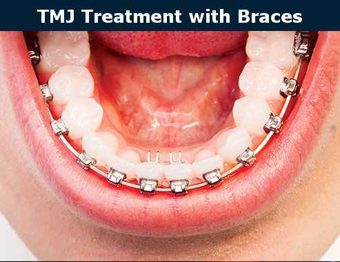 Will Insurance Cover Braces for TMJ – Expert Advice